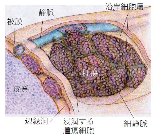 リンパ節介在血行性転移理論 新しいリンパ節転移理論とは Kodama Lab 東北大学大学院 医工学研究科 治療医工学講座 腫瘍医工学分野 小玉研究室